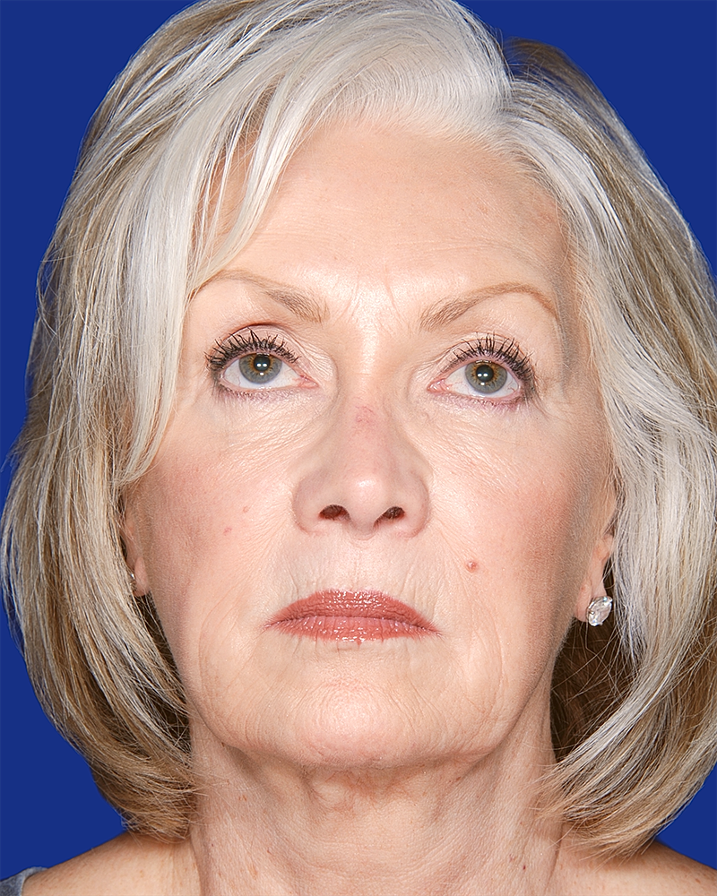 Facelift Before & After