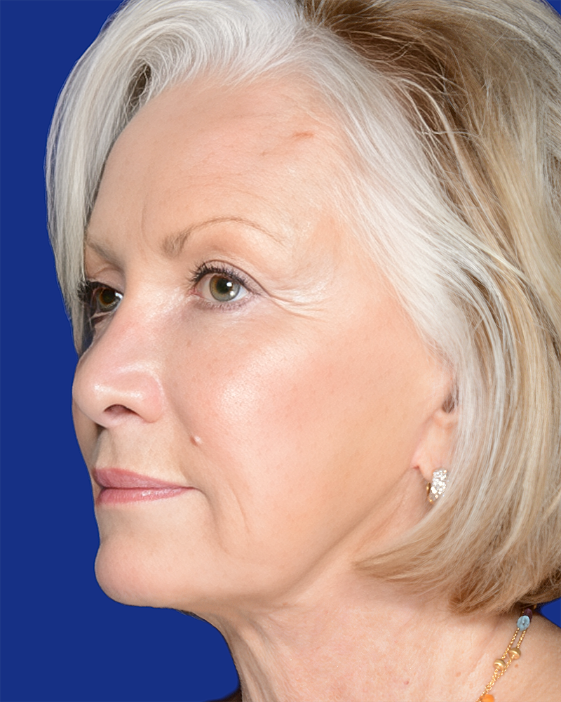Facelift Before & After