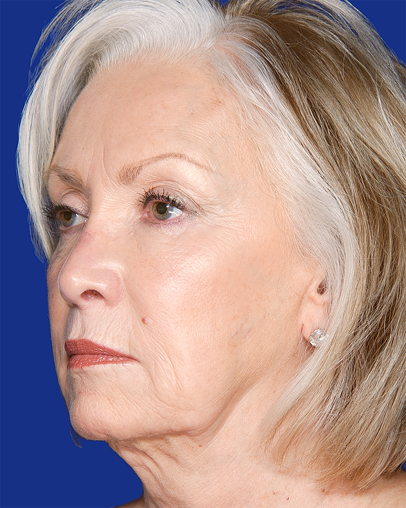 Facelift Before & After