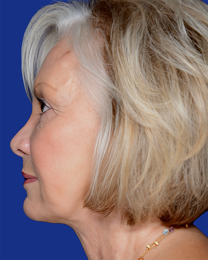 Facelift Before & After