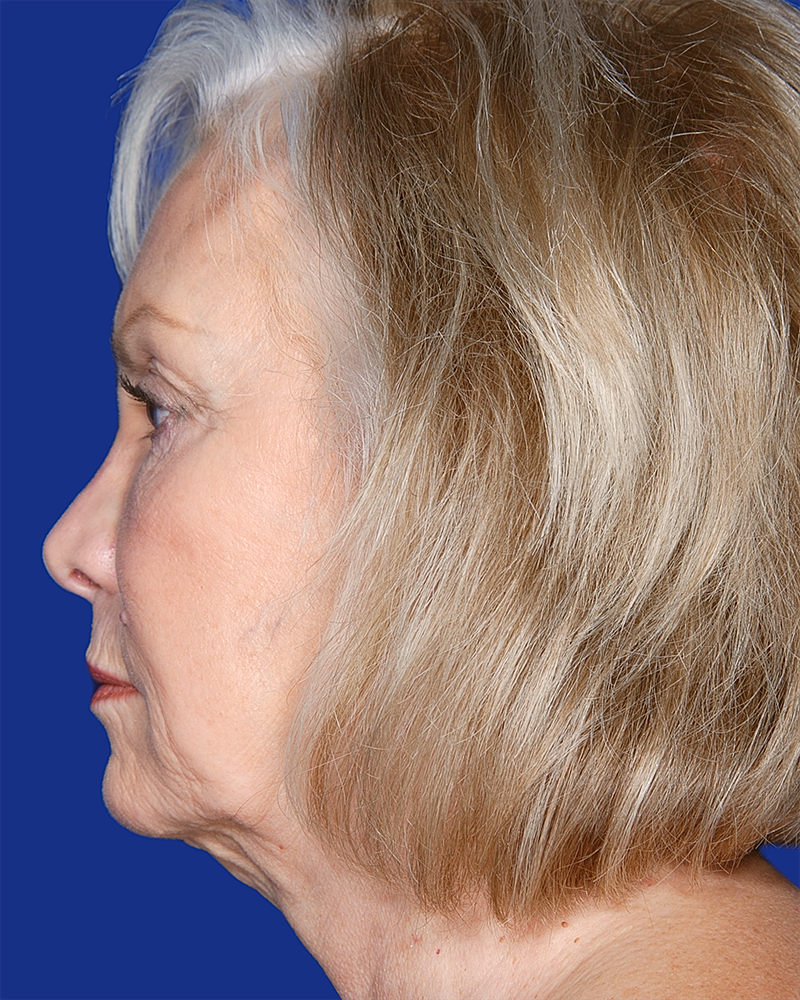 Facelift Before & After