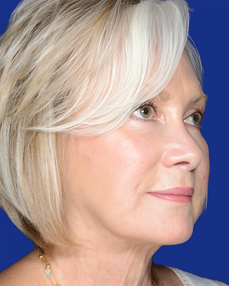 Facelift Before & After