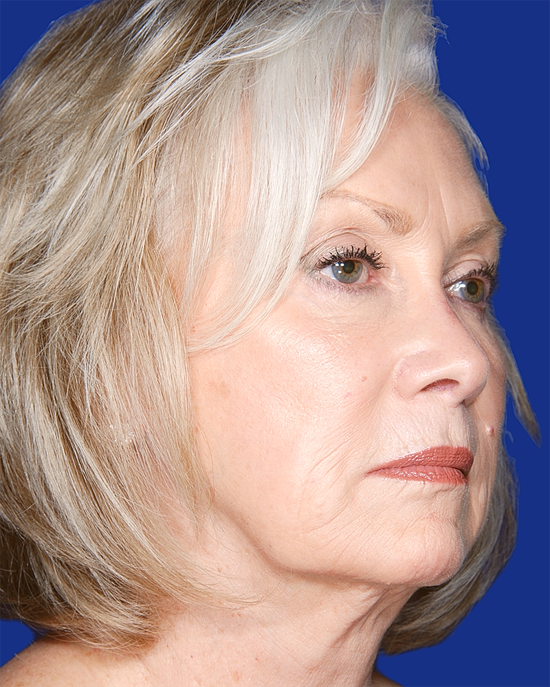 Facelift Before & After