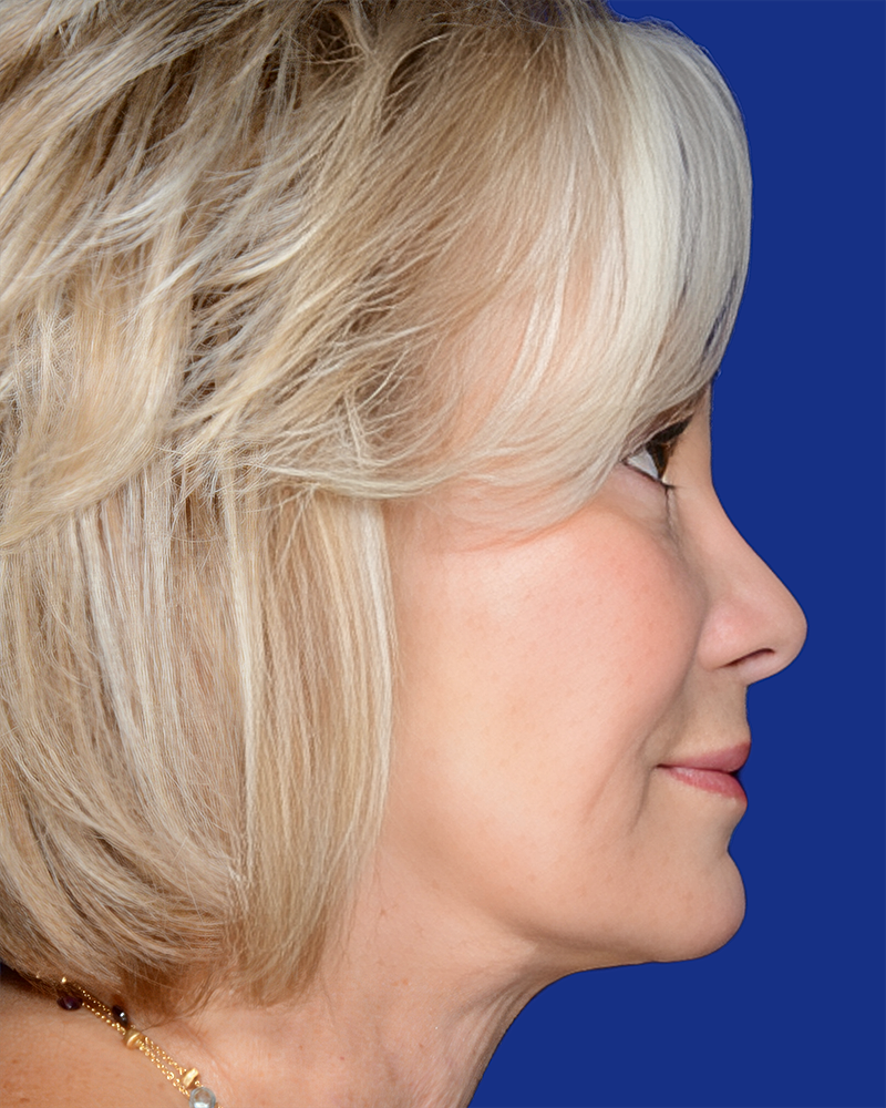Facelift Before & After