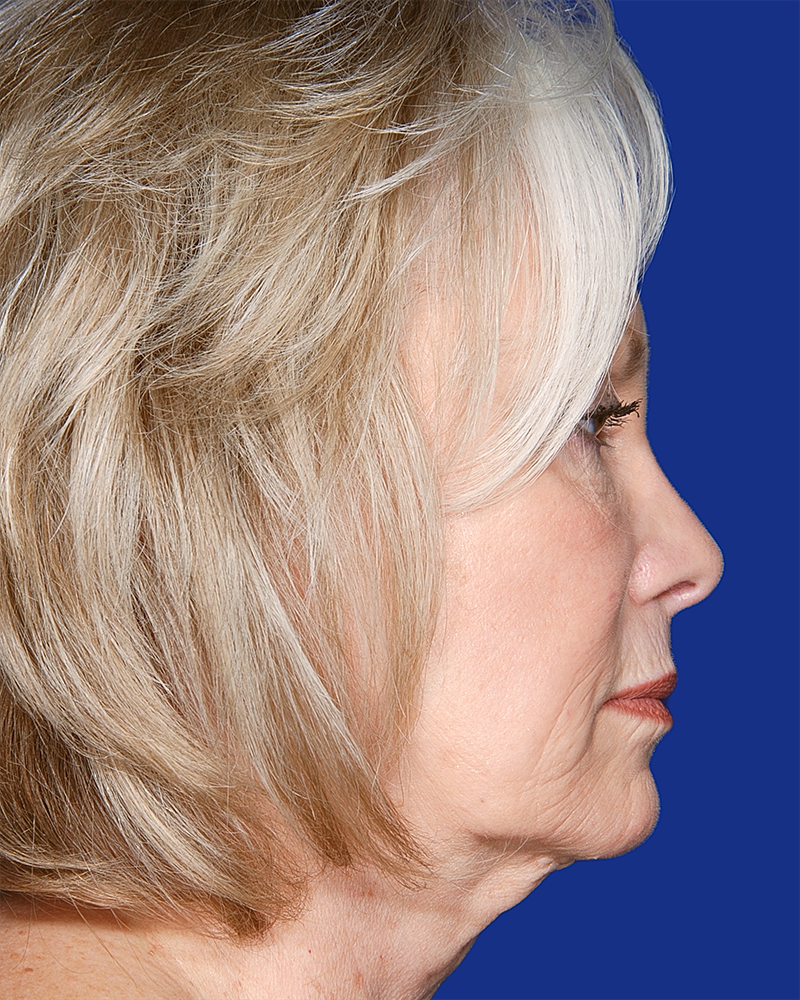 Facelift Before & After