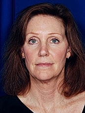 Facelift Before & After