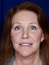 Facelift Before & After