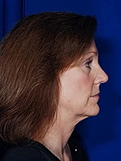 Facelift Before & After