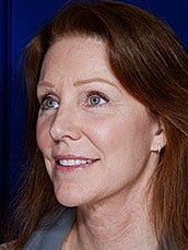 Facelift Before & After
