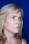 Facelift Before & After