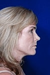 Facelift Before & After