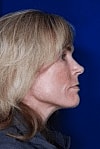 Facelift Before & After