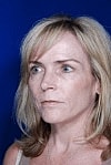 Facelift Before & After