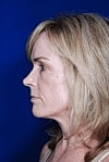 Facelift Before & After