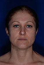 Facelift Before & After