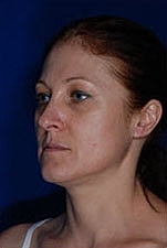 Facelift Before & After