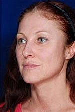 Facelift Before & After