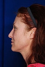Facelift Before & After