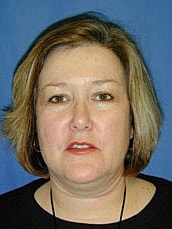 Facelift Before & After