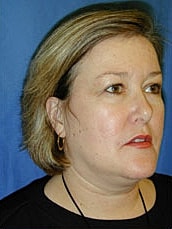 Facelift Before & After
