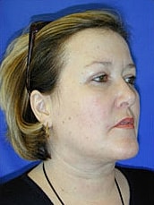 Facelift Before & After