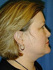 Facelift Before & After