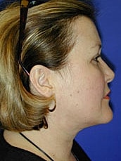 Facelift Before & After