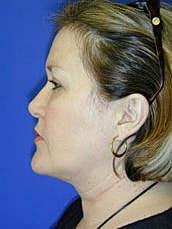 Facelift Before & After