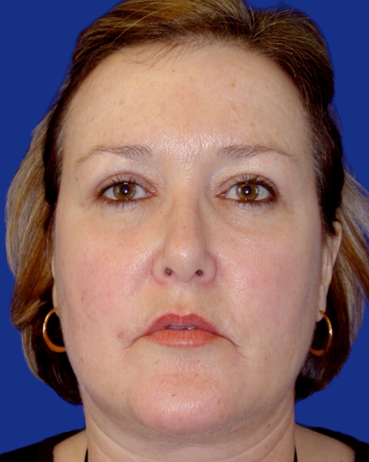 Facelift Before & After