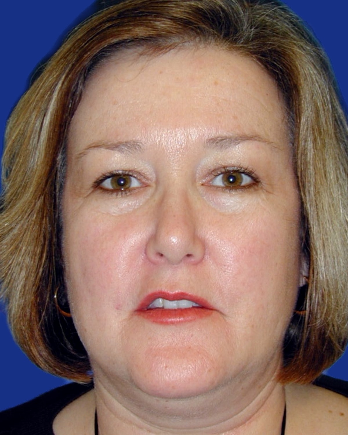 Facelift Before & After