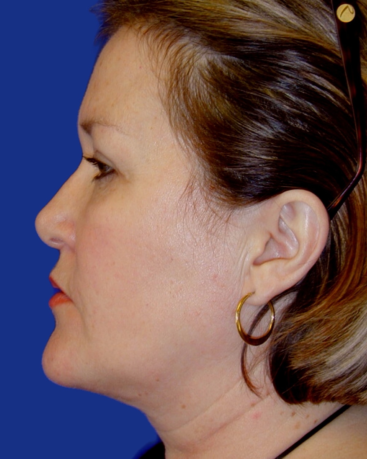 Facelift Before & After