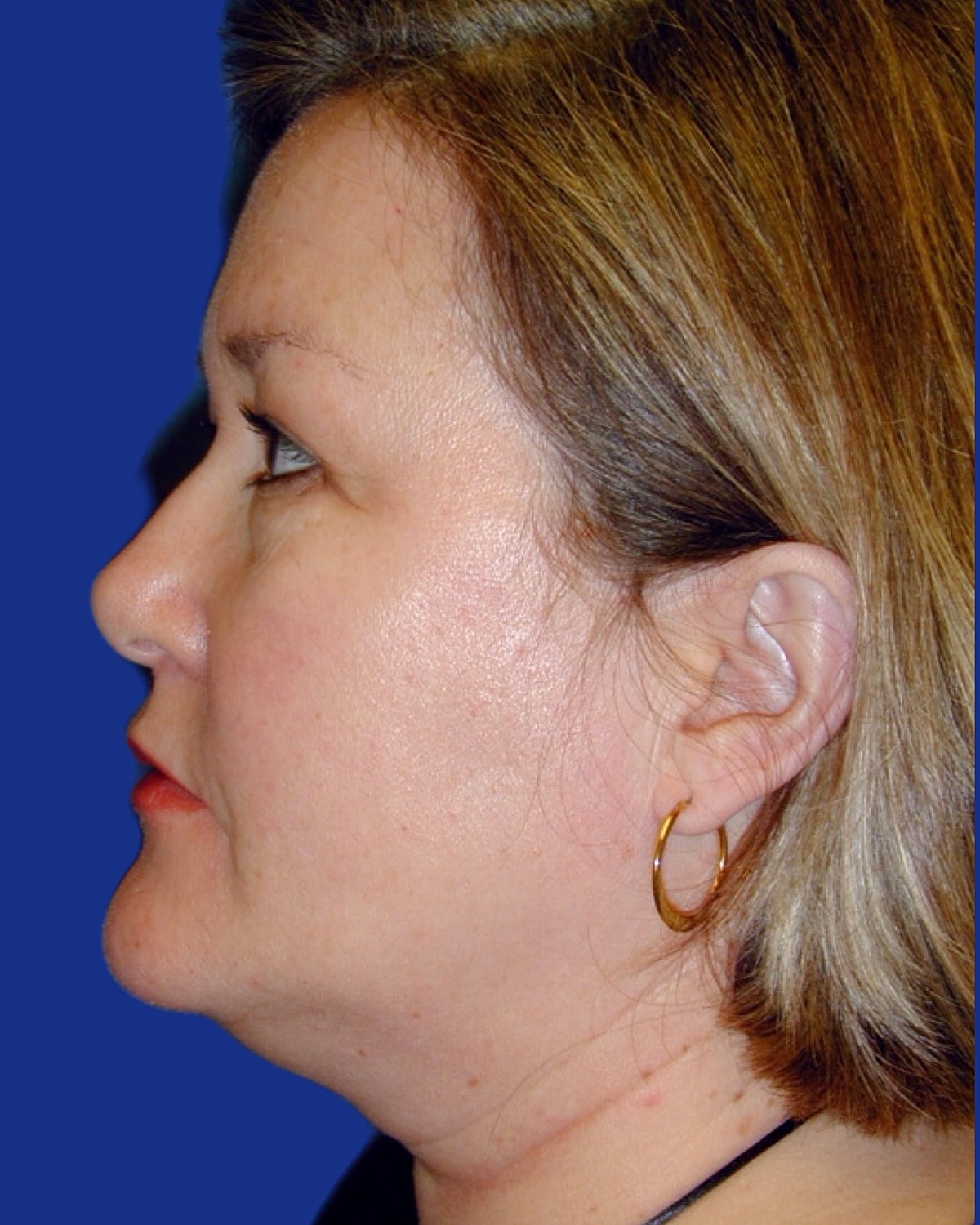 Facelift Before & After