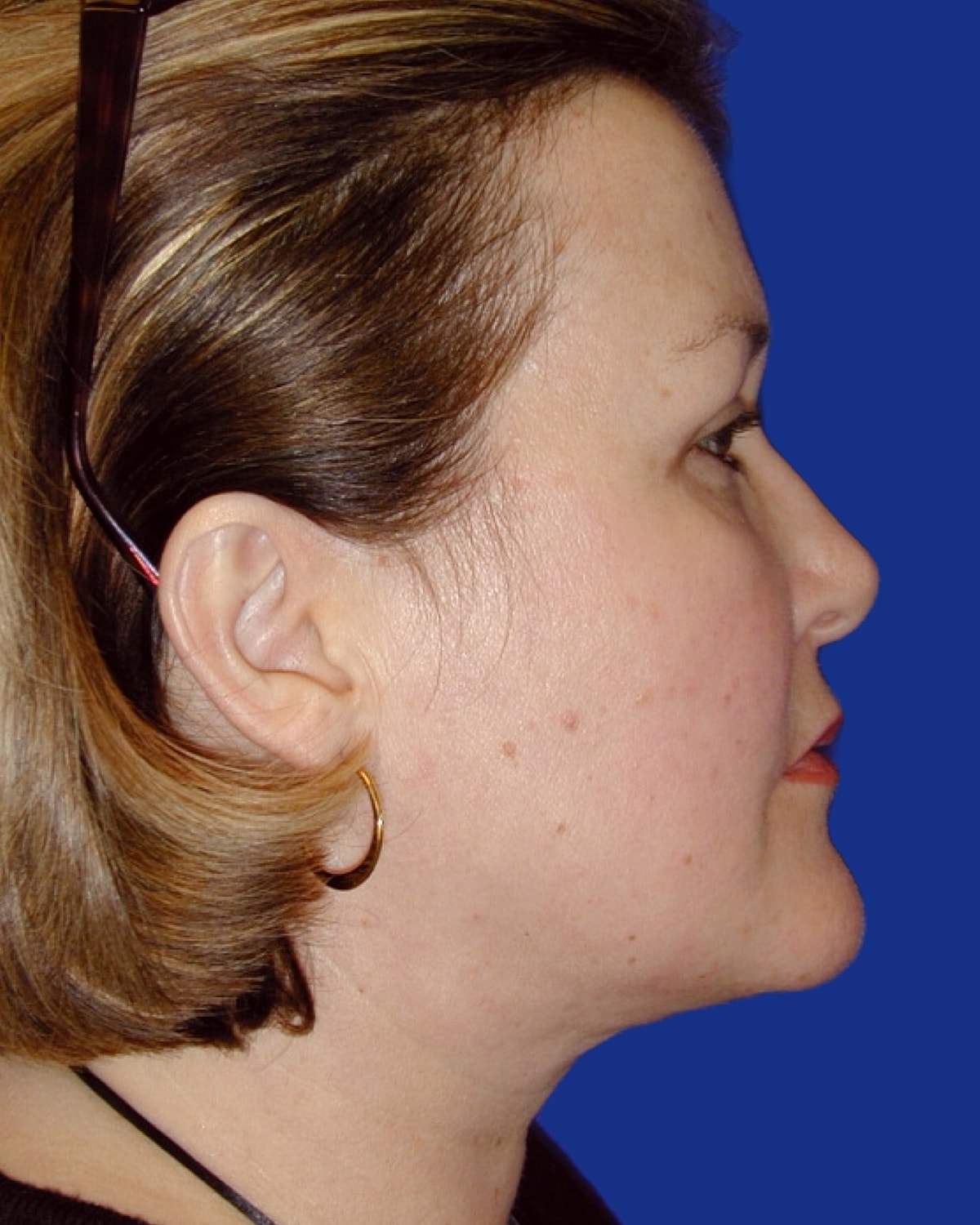 Facelift Before & After