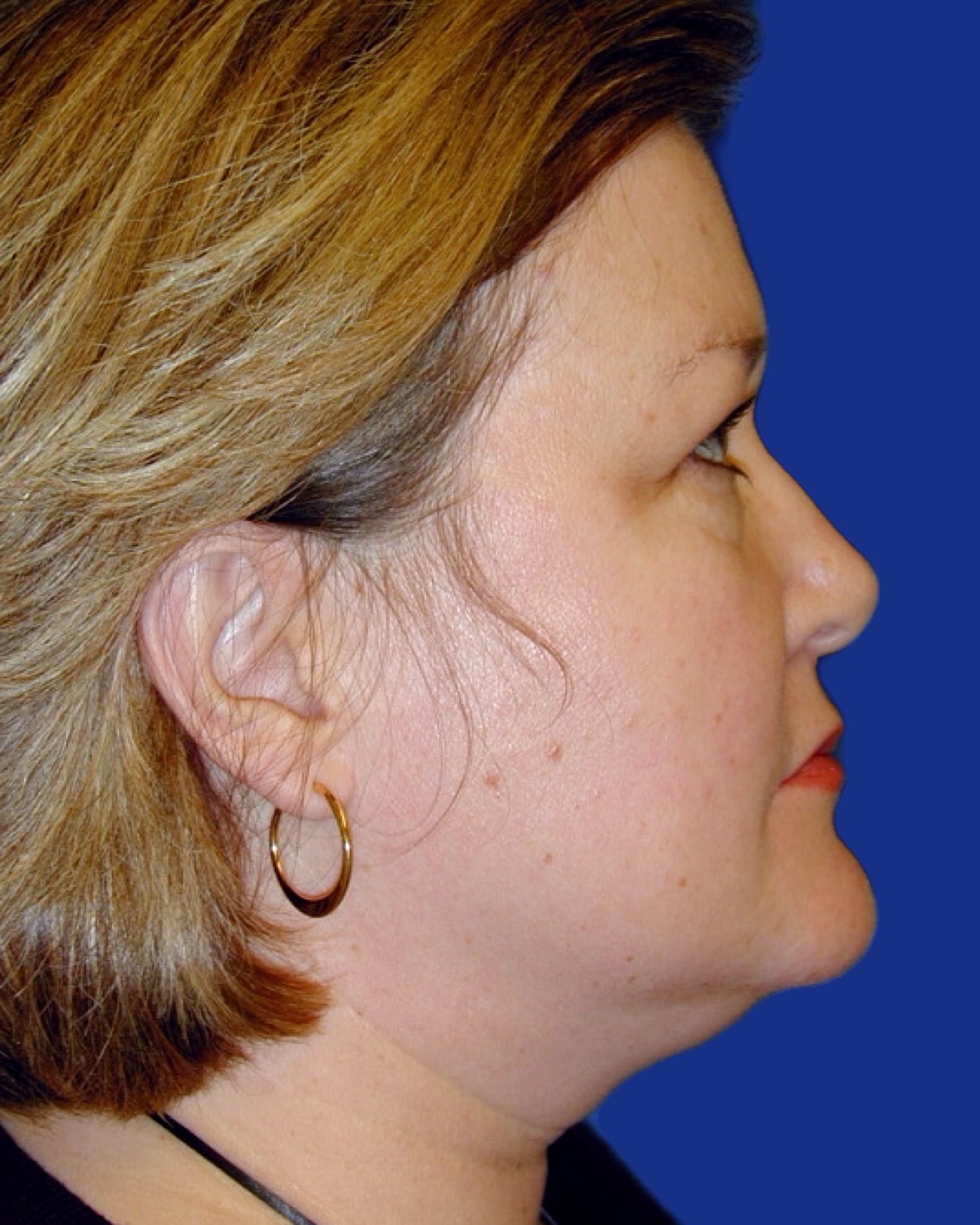 Facelift Before & After