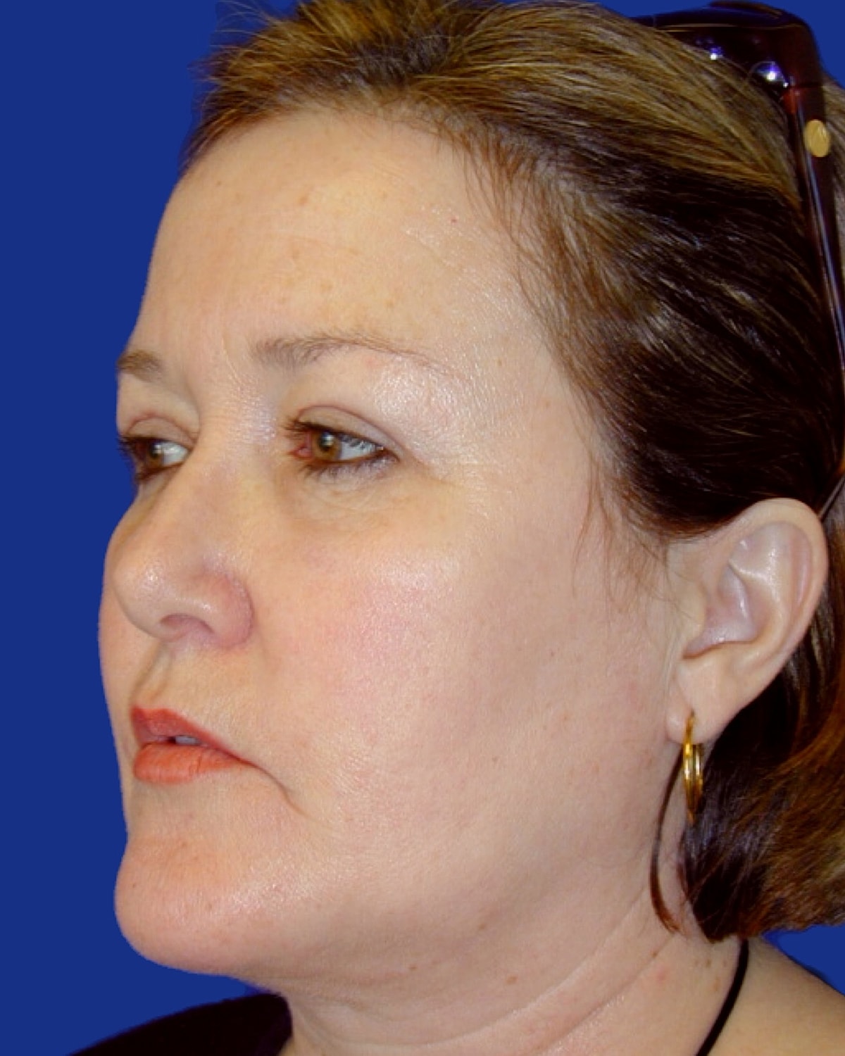 Facelift Before & After