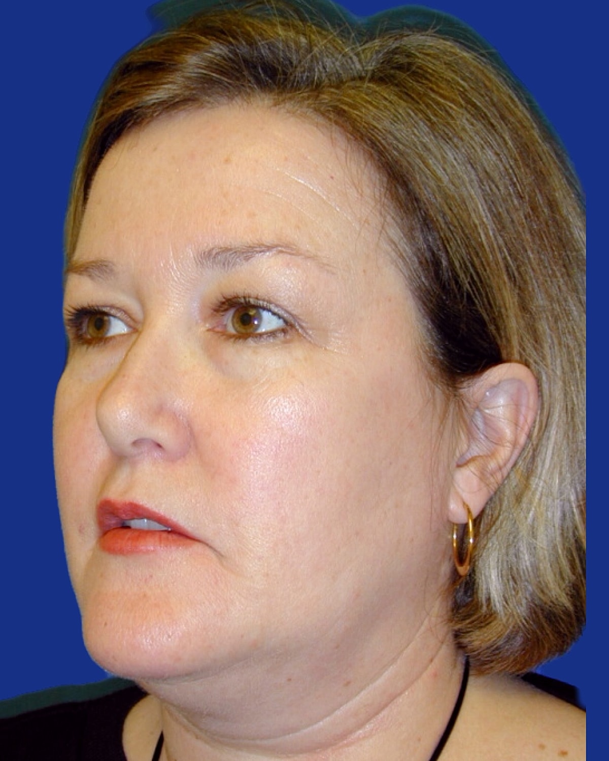 Facelift Before & After