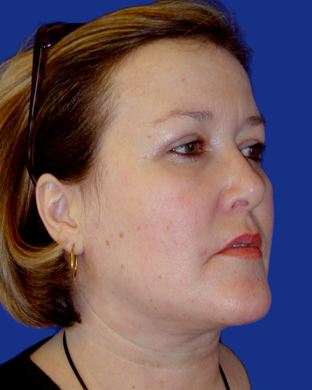 Facelift Before & After