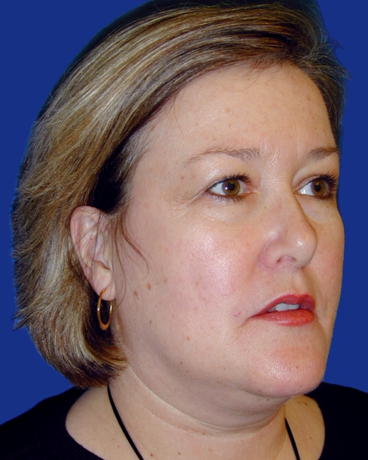 Facelift Before & After