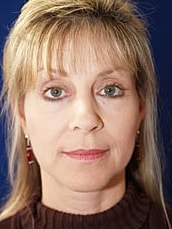 Facelift Before & After