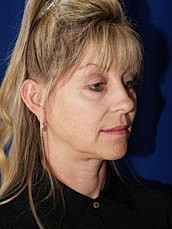 Facelift Before & After