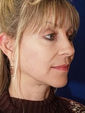 Facelift Before & After