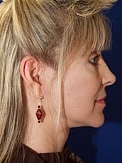 Facelift Before & After