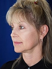 Facelift Before & After