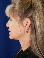 Facelift Before & After