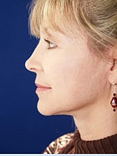 Facelift Before & After