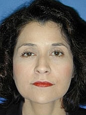 Facelift Before & After