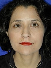 Facelift Before & After