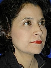 Facelift Before & After