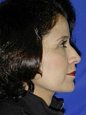 Facelift Before & After