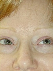 Facelift Before & After